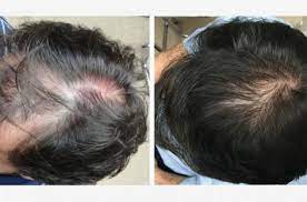 You might have heard about the new hair growth helmet that is being launched from a. Hair Loss News Latest Research Updates And Treatments