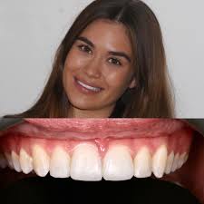 THE VB• 'Dr Dee, Here's a picture of my new smile! Thank you so much' One  of patients from Manchester who we have treated with complete replacement  dentures. That's right she has