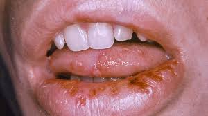 Image result for oral herpes symptoms roof of the mouth