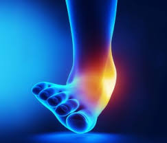 Image result for ankle sprain