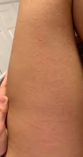 Rash with small red dots all over front,back,inner arms,buttocks&upper thighs. Itchy Rash On Inner Thighs And Arms What Is This Skin