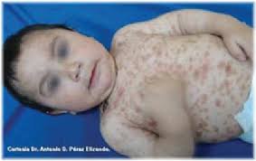 Image result for Urticaria pigmentosa children