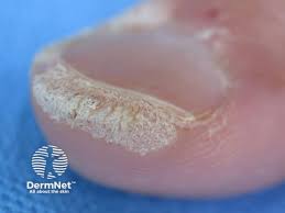 Image result for verrucae filiformes