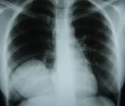 Φυματιώδης περικαρδίτιδα (mycobacterium tuberculosis) βακτηριακή περικαρδίτιδα (πνευμονιόκοκκος, σταφυλόκοκκος, λεγιονέλλα) μυκητιασική περικαρδίτιδα (ιστοπλάσμωση. Blog