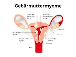 Gebarmuttermyom Gebarmuttermyome Myom Myome Medikamentose Behandlung