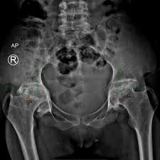 Laparoscopic understanding of pelvic anatomy and its application in benign and radical pelvic surgery. Otto Pelvis Eurorad