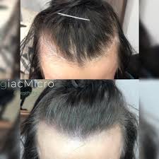 Scalp micropigmentation helps restore confidence in men & women who are struggling with thinning hair. Scalp Micropigmentation Giacmicro