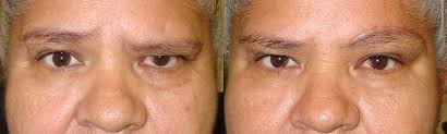 Bell's palsy treatment with acyclovir and prednisone compared with prednisone alone: How Can An Oculoplastic Surgeon Help Treat Bell S Palsy Taban Md