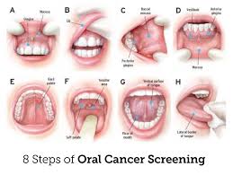 The cancer has not spread to the lymph nodes or other places in your body. Oral Cancer Screening Dr Oscar Dalmao Associates