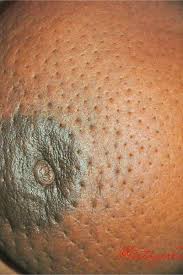 It blocks the lymph vessels in the skin of your breast. Beta Girls Organization On Twitter Take A Good Look At The Skin Surrounding The Nipple Look At The Nipple Also It Is Called Dimpling Of The Skin Like The Skin On An