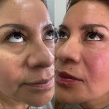 Skin Heaven ☁️✨ Rodeo Drive + OC Med Spa (@skinheavenmedspa) • Instagram  फोटोहरू र भिडियोहरू