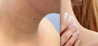 Propylene Glycol Allergic Contact Dermatitis And Topical Corticosteroids