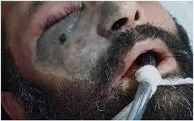 يحدث التهاب الأظافر الفطر عندما تصيب الفطريات واحداً أو أكثر من الأظافر الخاصة بك. Ù…Ø§ Ù‡Ùˆ Ù…Ø±Ø¶ Ø§Ù„ÙØ·Ø± Ø§Ù„Ø£Ø³ÙˆØ¯ ÙŠØªØ³Ø¨Ø¨ ÙÙŠ Ø¥ØªÙ„Ø§Ù Ø§Ù„Ø¹ÙŠÙ† ÙˆØ§Ù„Ø£Ù†Ù Ù‚Ø¨Ù„ Ø§Ù„ÙˆØµÙˆÙ„ Ù„Ù„Ø¯Ù…Ø§Øº Ù…ØµØ± Ø§Ù„ÙˆØ·Ù†