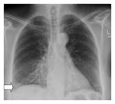 Pa Chest X Ray Showing Ill Defined Opacity Right Lower Zone Arrow Download Scientific Diagram