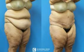 Maybe you would like to learn more about one of these? Chicago And Hinsdale Abdominoplasty And Tummy Tuck Krochmal Plastic Surgery