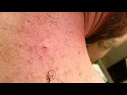 It may turn red, containing a foul smelling yellowish fluid when popped or drained. Ingrown Hair Removal Gross Videos Armpit Face Stomach