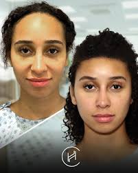 📸✨Before & After: A New Forehead, A New Confidence! “Every millimeter  makes a difference!” 💫 Meet our patient's incredible transformation after  forehead reduction surgery! 👏 🔍 Natural-looking results ⏱ Quick recovery  🤖