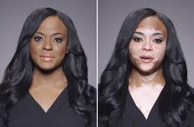 Vitiligo global issue consensus conference panelists. Dermablend S New Campaign Will Make You Feel Feelings Vitiligo Treatment Vitiligo Vitiligo Cure