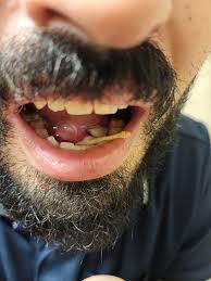 Image result for Sialoadenitis