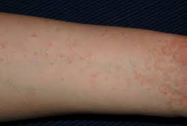 Image result for scabies symptoms