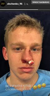 15 способов украсить новогодний стол так, что все обалдеют. Ukrainskij Futbolist Zinchenko Poluchil Tyazheluyu Travmu Nosa V Matche Za Man Siti Foto Chitat Na Golos Ua