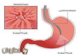 وصفات مجربة من العسل لعلاج قرحة المعدة عطار زمان