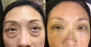 眼袋的形成，会阻碍血液循环，造成黑眼圈，变大了以后还会形成下赘，后期皮肤弹性逐渐被撑得松弛，从而支撑不了，形成更严重的双层型眼袋和严重的黑眼圈。  所以说#