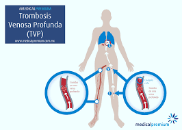 Jul 02, 2021 · la trombosis venosa profunda (tvp) es una afección que sucede cuando se forma un coágulo sanguíneo en una vena que se encuentra profundo dentro de una parte del cuerpo. Trombosis Venosa Profunda Y Embolia Pulmonar Medical Premium