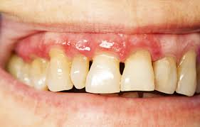 Understanding The Link Between Periodontal Disease And Diabetes