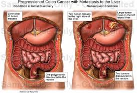 Find information metastatic cancer from the cleveland clinic, including symptoms & treatment options for different types of cancer. When Colon Cancer Metastasized To The Liver