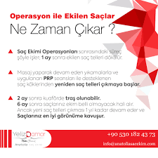 Operasyon Ile Ekilen Saclar Ne Zaman Cikar 2 Ay Sonra Kuaforde Tras Olunabilir 6 Ay Sonra Saclariniz Ekim Yapildigi Belli Olamayacak Yeni Sac Sac Kuaforler