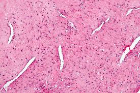Nasopharyngeal Angiofibroma Wikipedia