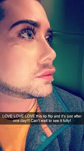 Lip flip &/or filler recommendations?