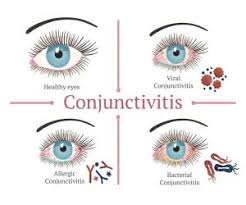 Image result for Conjunctivitis Resources
