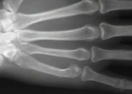 We did not find results for: Boxer S Fracture Metacarpal Neck Wheeless Textbook Of Orthopaedics