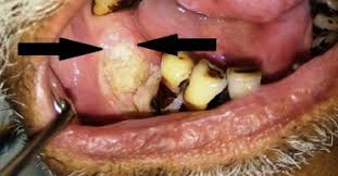 Image result for Thrush