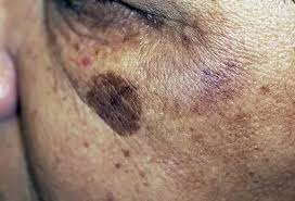 Image result for Solar Lentigo