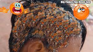 Jan 27, 2018 · large flakes falling off your scalp could be very embarrassing. Psoriasis Huge Flakes Remove Dandruff Flakes 208 Youtube
