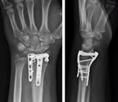 PDF] Distal radius volar rim plate: Technical and ...