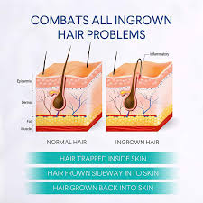 Sunscreen helps to prevent it from getting worse. Oem After Shave Razor Bump Stopper Waxing Skin Care Solution For Soothes Skin Prevents Ingrown Hairs With Dark Spots Removal Buy After Shave Solution After Shave Lotion After Shave Lotion Men Product On Alibaba Com