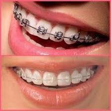 How much does braces cost in maryland. Average Cost Of Braces Best Orthodontist Nyc