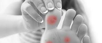Maybe you would like to learn more about one of these? Shedding Light On Plantar Wart Myths Southern California Foot Ankle Specialists