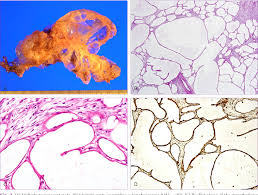 Check spelling or type a new query. Pdf Multicystic Benign Mesothelioma Of The Pelvic Peritoneum Presenting As Acute Abdominal Pain In A Young Woman Semantic Scholar