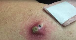 The video, posted on ladbible, shows jacob acosta, 23, literally squeezing every single blackhead out of his nose in the span of two seconds. Best Dr Pimple Popper Blackhead Extraction Videos Ever