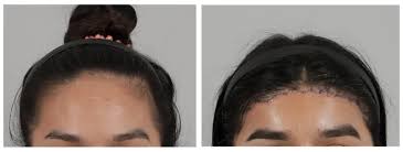 A widows peak can be frustrating to. Is Hairline Lowering Surgery Right For Me Idhospital