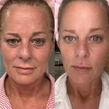 Hold the phone while I go wash my face again!! Hello GORGEOUS!! Jami-Laura  Copeland these results don't lie!! “New skin health system. Who dis? Just  leveled up my skinhealth. Like… BIG time.
