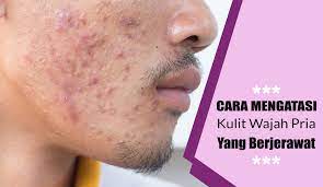 Kalo jf sulfur sendiri menyarankan kalo lebih baik atasi jerawat yang ada dulu dengan oily care/acne anonim 19 mei 2014 00.19. 11 Cara Menghilangkan Jerawat Pria Yang Harus Kamu Coba