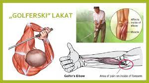 Teniski lakat nije samo povreda profesionalnih sportista. 12 Epicondylitis Humeri Ili Teniski Lakat Medicinska Kola