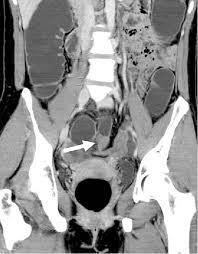 Endometriosis is an abnormal growth of endometrial cells found in the uterus. Figure 3 From Bowel Endometriosis Ct Enteroclysis Semantic Scholar