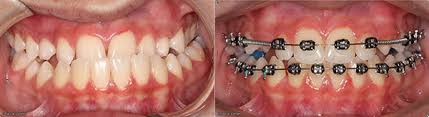 Correcting an underbite can be achieved in any number of ways, but it mostly depends on severity, age, and overall medical based on your particular set of circumstances, your orthodontist may follow up with braces or a retainer at this point to ensure a permanent fix. Wilmette Orthodontist Braces Specialist Explains Underbites